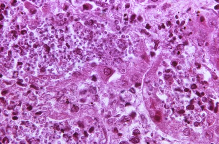Candidiasis in kidney tissue. From Public Health Image Library (PHIL). [2]