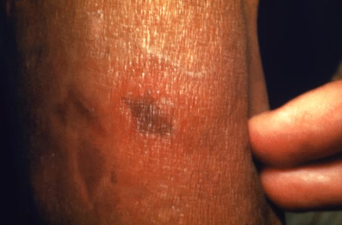 Erythema necroticans or “Lucio's phenomenon”, or “spotted leprosy of Lucio”. Adapted from Public Health Image Library (PHIL), Centers for Disease Control and PreventionPublic Health Image Library (PHIL), Centers for Disease Control and Prevention[5]