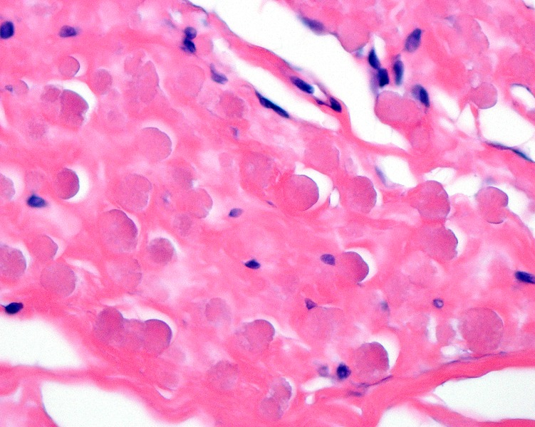 File:Lossy-page1-751px-Hematoxylin and Eosin stained photomicrograph of an elastofibroma LDRT tif.jpg