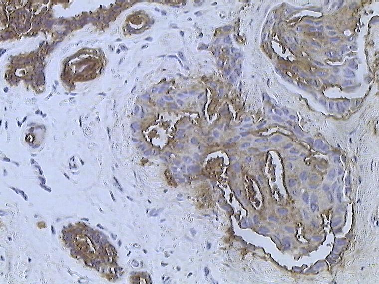 Infiltrating ductal carcinoma of the Breast assayed with anti Mucin 1 antibody