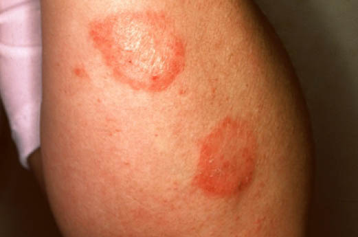 File:Nummular dermatitis dry.jpg