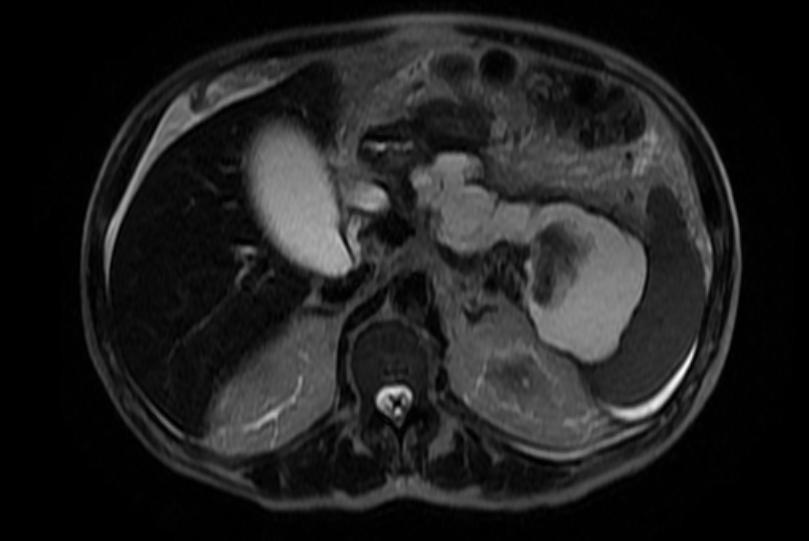 Computerized tomography: Pancreatic pseudocyst