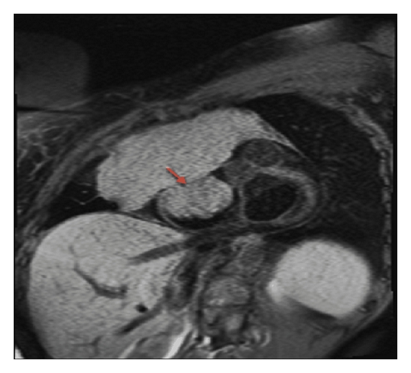Cardiac MRI short axis T1 at the level of mitral valve reveals a large mediastinal mass infiltrating and obliterating the SVC causing SVC obstruction. The tumor extends into the right atrium (red arrow) and invades the tricuspid valve.[16]