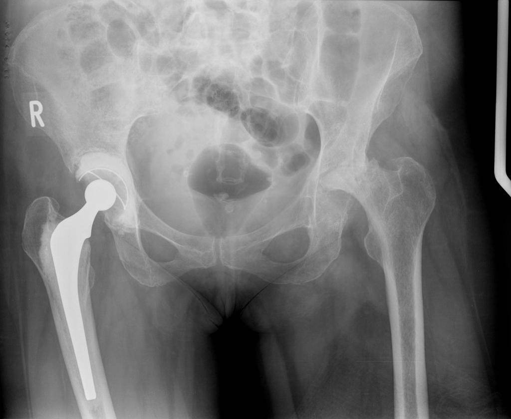 File:Rheumatoid-arthritis-of-hip-with-erosion-and-pseudoarthrosis.jpg