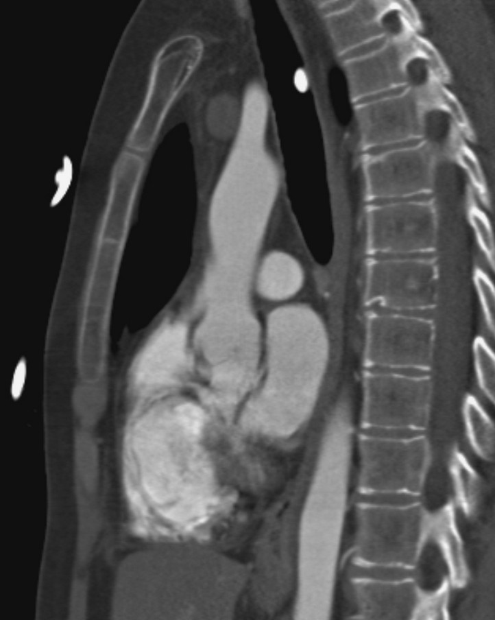 This patient collapsed on the ward and was thought to have had a pulmonary embolus. A CTPA revealed a tablet lying dependently in the patient's trachea, with changes of aspiration in both lower lobes (not shown). A second tablet was visible in the stomach... the tablet was removed via a bronchoscope and confirmed to be a Slow K (potassium). (Image courtesy of Dr Frank Gaillard)