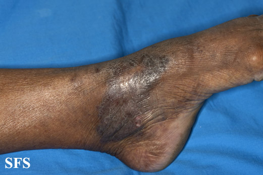Acroangiodermatitis. Adapted from [http://www.atlasdermatologico.com.br/disease.jsf?diseaseId=9