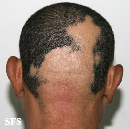 File:Alopecia areata 21.jpeg