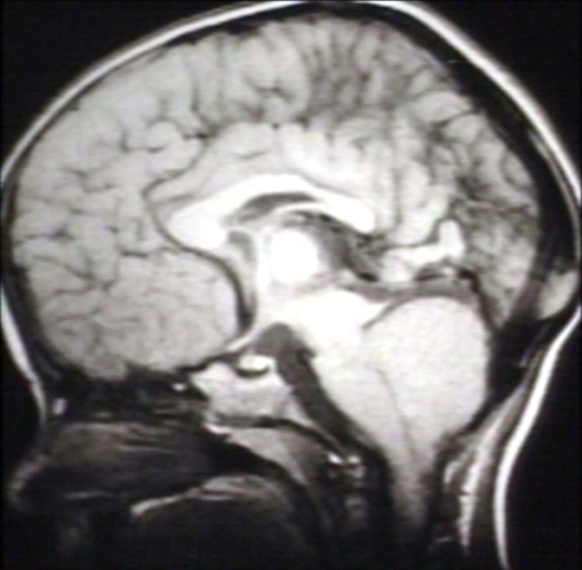 Brain: Arnold Chiari II, with Tectal Beaking and Large Massa Intermedia and Stenogyria; T1 (MRI)