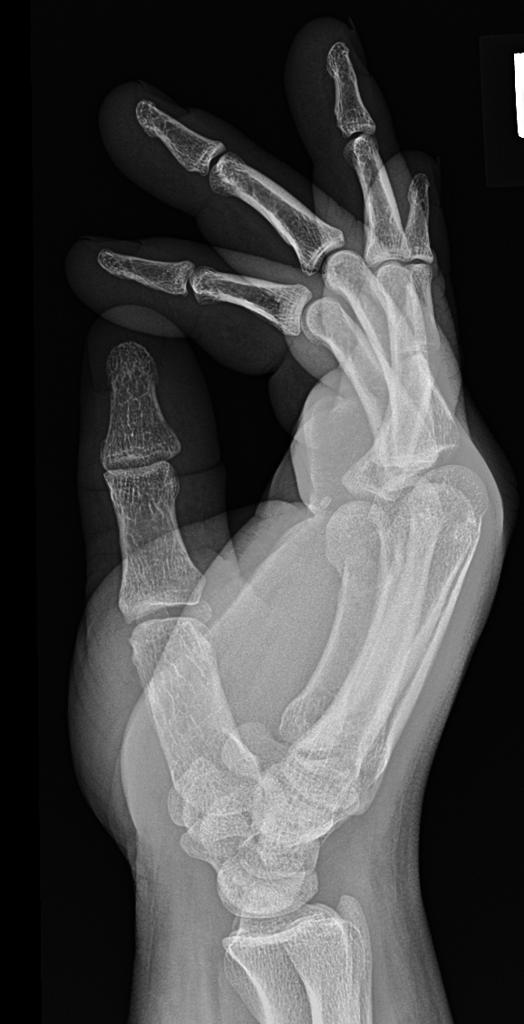 5th metacarpal neck fracture consistent with a boxer fracture.
