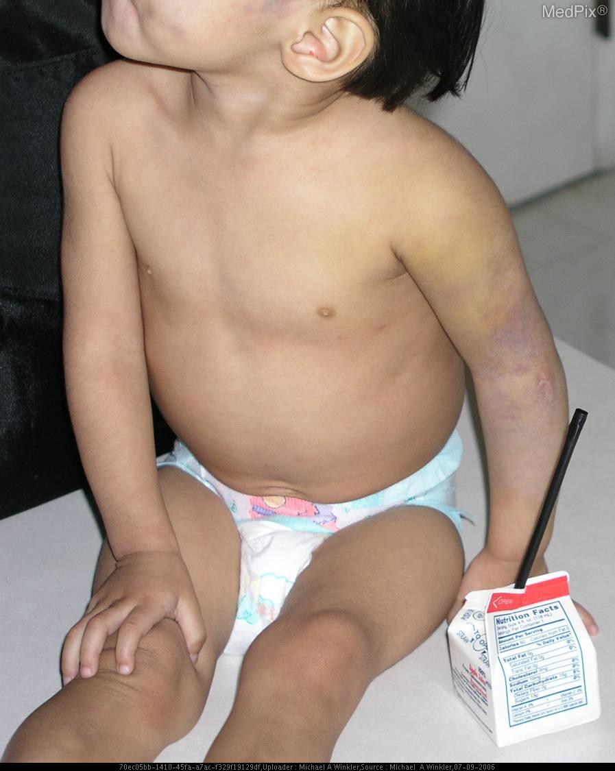 File:Bruises 1 Non accidental trauma.jpg