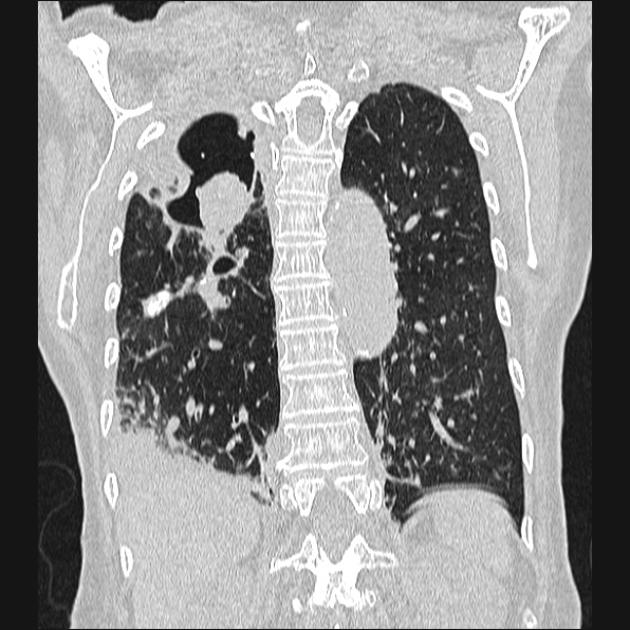 Chest CT scan demonstrating a well rounded mass located inside a cavity of the right lung, and surrounded by a crescent of air