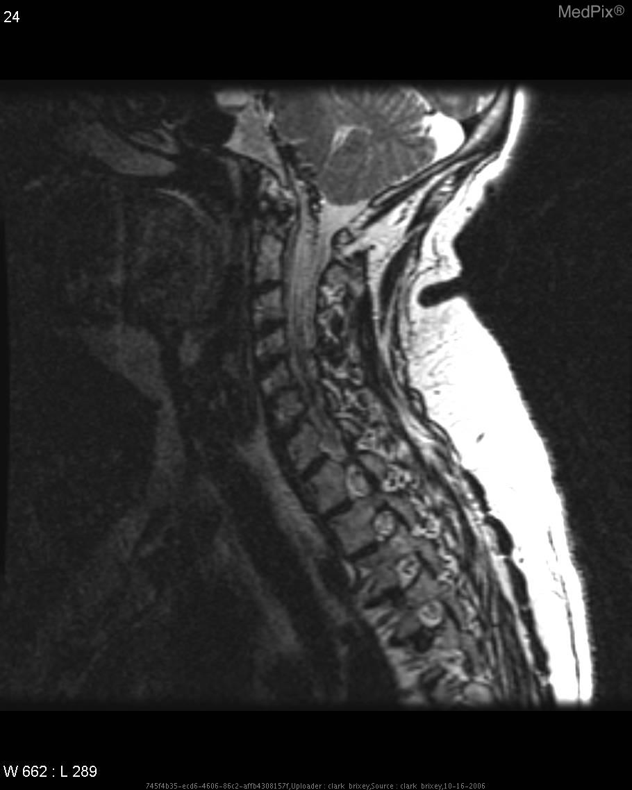 File:Dural AVF, cervical spine 3.jpg