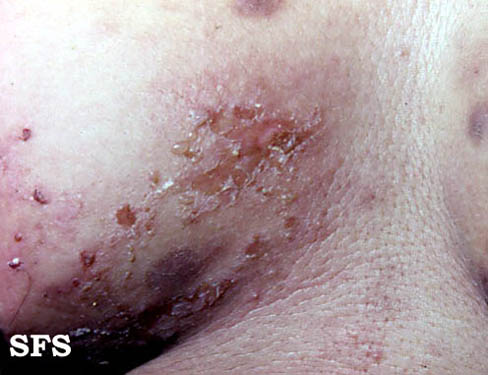File:Herpes gestationis 02.jpeg