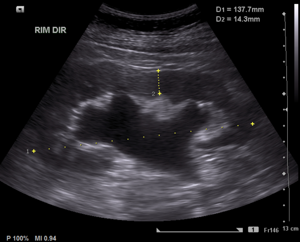 File:Hydronephrosis-due-to-ureteral-stones.png