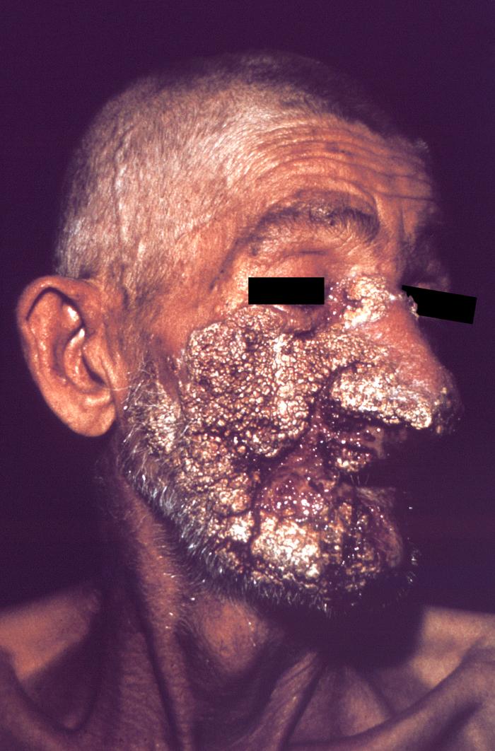 This image from 1965 depicted a right anterior-oblique view of a Sao Paulo, Brazilian man’s face that displayed the severely-destructive cutaneous pathologic changes seen there, due of the mycotic infection, paracoccidioidomycosis. Symptoms involve ulcerations of the skin and mucous membranes of the mouth, nose and pharynx.[9]