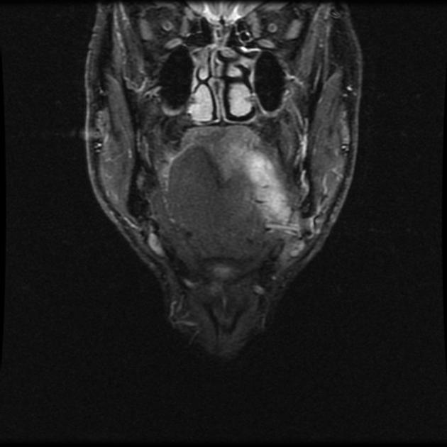 File:Pleomorphic adenoma MRI.jpeg