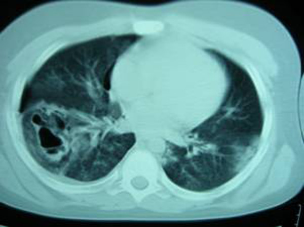 A chest CT scan revealing pulmonary contusions, pneumothorax, and pseudocysts