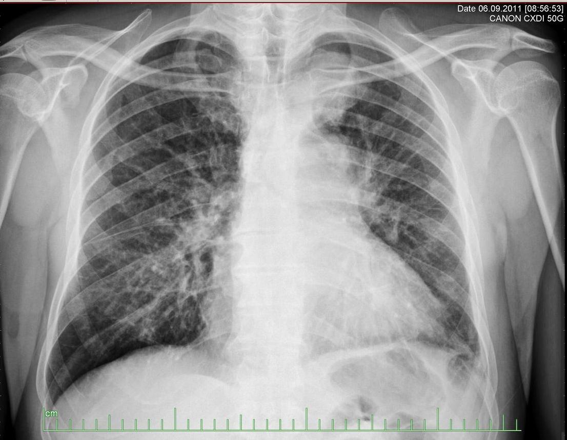 Small Cell Lung Cancer Chest X Ray