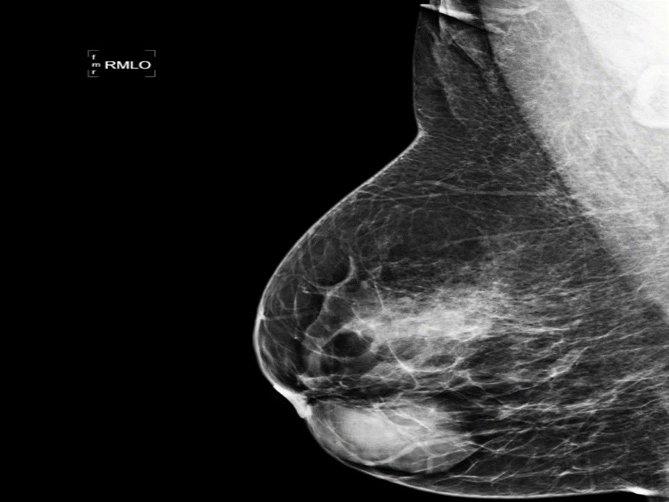 File:Breast fibroadenoma mammography.gif