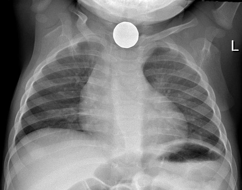 Chest X-ray showing a coin in the esophagus of a young child
