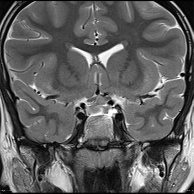 Coronal T2 MRI of suprasellar germinoma[7]