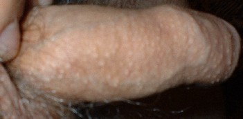 Example of Fordyce's spots on a penis.