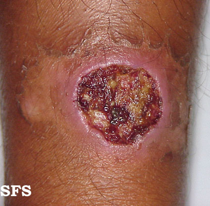 Tropical ulcer. Adapted from Dermatology Atlas.[6]