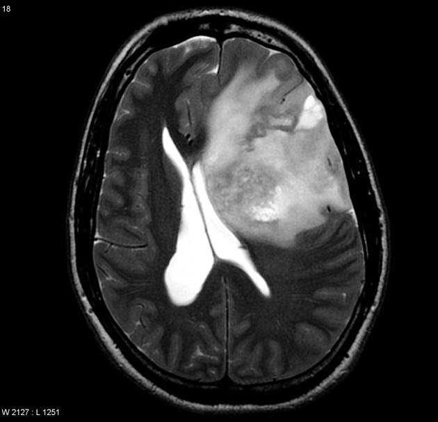 MRI including post contrast sequences demonstrates a large mass involving the majority of the left frontal lobe, which exerts significant mass effect resulting in midline shift and effacement of the frontal horn of the lateral ventricle. The mass is heterogeneous, but predominantly hyperintense on T2 with a surrounding mantle of tumor edema. Following contrast there is heterogeneous moderate enhancement.[4]