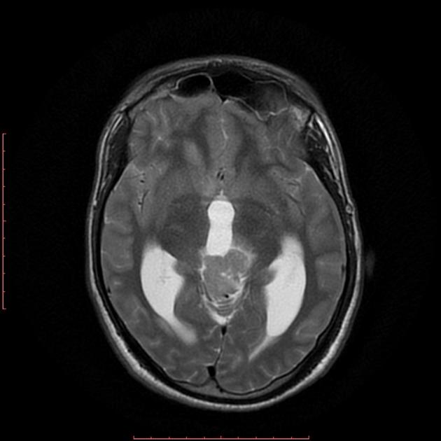 Axial T2-weighted MRI image demonstrating a lesion that is hyperintense.[23]