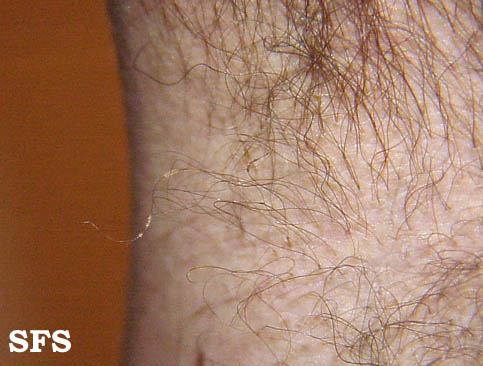 Trichomycosis axillaris. Adapted from Dermatology Atlas.[1]