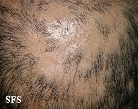 File:Alopecia areata 23.jpeg
