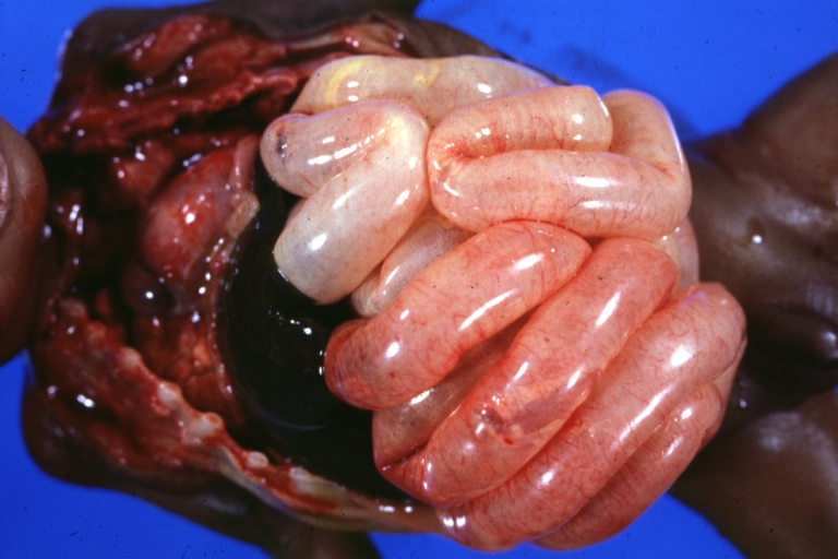 Intestine: Ileus Newborn Cause Unknown: Gross natural color close-up view of distended gut loops