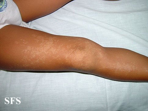 Incontinentia pigmenti achromians of Ito. Adapted from Dermatology Atlas.[2]