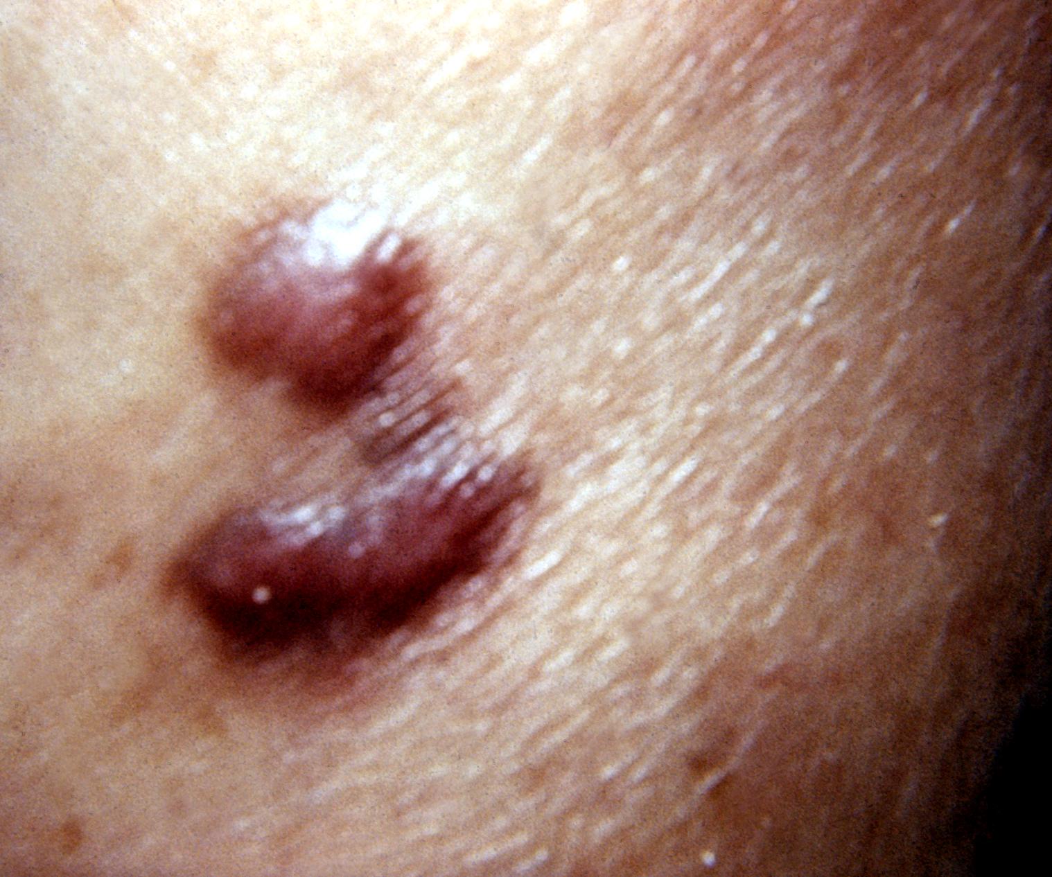 Kaposi sarcoma lesion Source: Wikimedia Commons.[16]