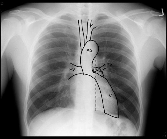 The chest x-ray in cardiovascular disease - wikidoc