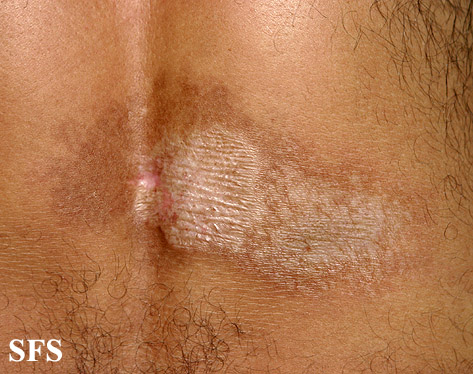 Lichen sclerosus et atrophicus. Adapted from Dermatology Atlas.[2]