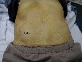 Markedly enlarged gall bladder