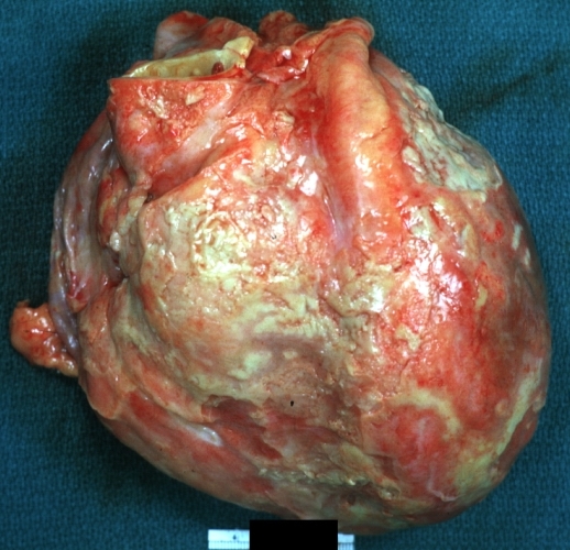 Fibrinous pericarditis: Gross, intact heart, good example.