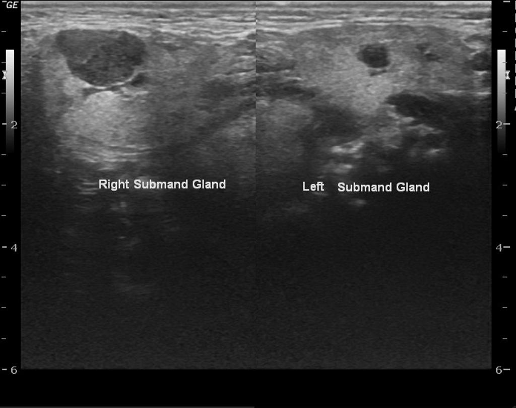 Ultrasound showing submandibular gland lesion[7]