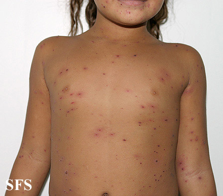 Varicella From Public Health Image Library (PHIL). [3]