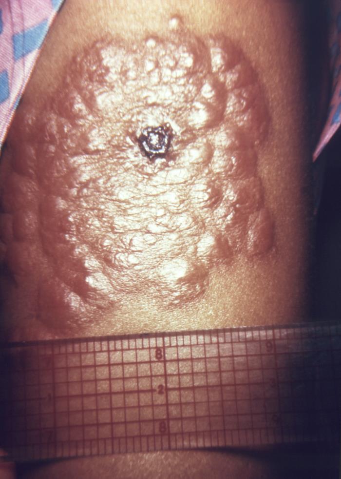 Left upper arm of a middle-aged woman who’d received a primary smallpox vaccination, and thereafter, developed local erythema, and a “bull’s eye” surrounding the site. From Public Health Image Library (PHIL). [5]
