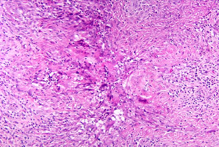 Histopathologic changes associated with phaeohyphomycosis due to P. parasitica using H&E stain. From Public Health Image Library (PHIL). [3]