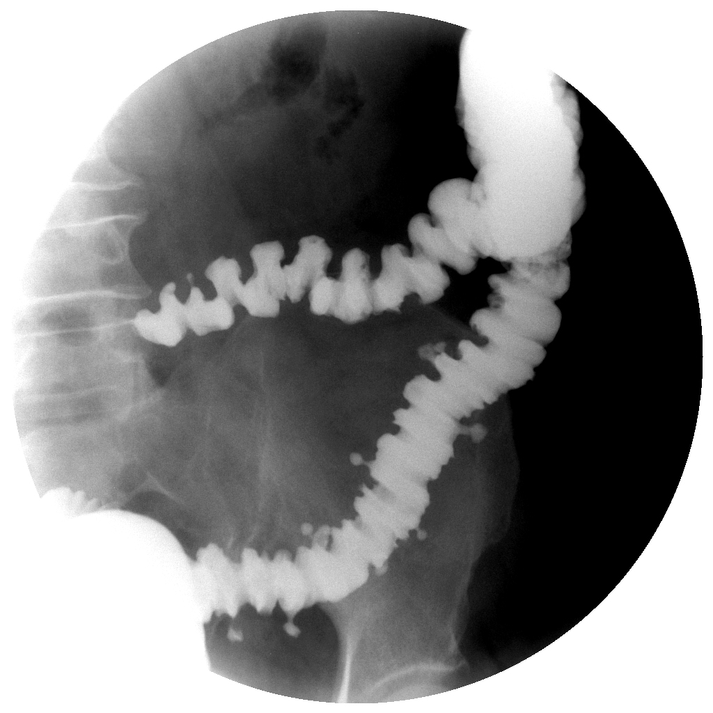 File:Colonic-diverticulosis-on-single-and-double-contrast-barium-enema.jpg