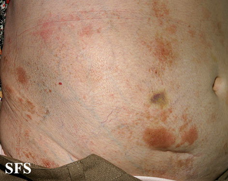 Large plaque parapsoriasis. Permission from from Dermatology Atlas.[4]