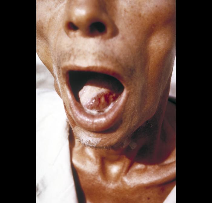 Captured prior to beginning any treatment, this image depicts an anterior view of a male patient’s open mouth, revealing the man’s tongue, which exhibited a lesion on its left lateral edge that proved to be a case of paracoccidioidomycosis.[10]