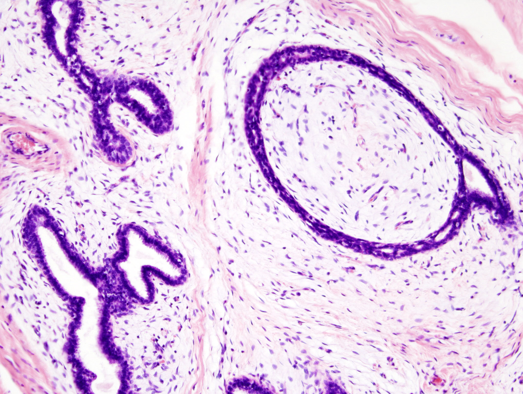 Histopathologic image of breast fibroadenoma. Core needle biopsy. Hematoxylin & eosin stain.