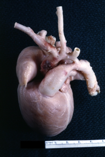 AORTA: Coarctation: Gross, hypoplastic aortic arch and infantile coarctation well demonstrated.