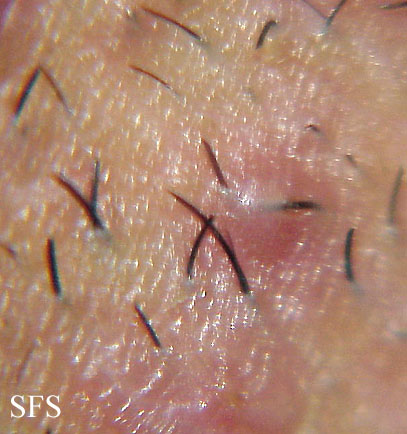 Pseudofolliculitis barbae. With permission from Dermatology Atlas.[1]