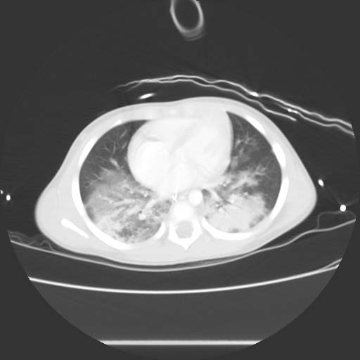 CT image demonstrates bilateral pulmonary contusions