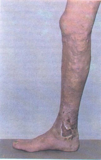 File:Pyoderma gangrenosum (IBD).jpg